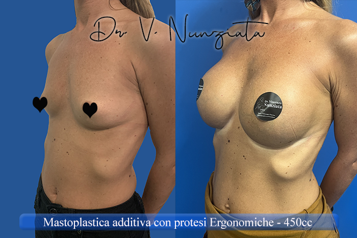 Mastoplastica additiva – protesi ergonomiche prima e dopo – Paziente 32 – Dr. Vincenzo Nunziata, chirurgo plastico – foto 4