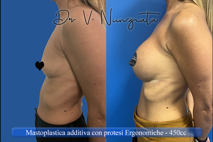 Mastoplastica additiva – protesi ergonomiche prima e dopo – Paziente 32 – Dr. Vincenzo Nunziata, chirurgo plastico – foto 3