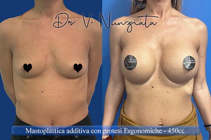 Mastoplastica additiva – protesi ergonomiche prima e dopo – Paziente 32 – Dr. Vincenzo Nunziata, chirurgo plastico – foto 1
