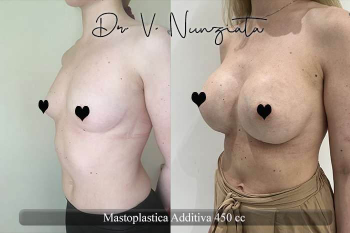 Mastoplastica additiva – protesi rotonde prima e dopo – Paziente 56 – Dr. Vincenzo Nunziata, chirurgo plastico – foto 3