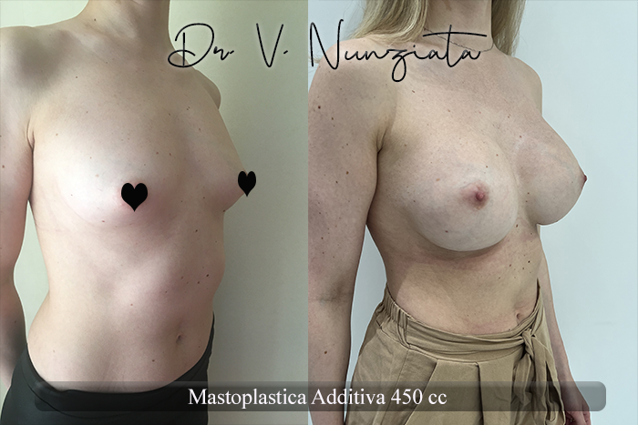 Mastoplastica additiva – protesi rotonde prima e dopo – Paziente 56 – Dr. Vincenzo Nunziata, chirurgo plastico – foto 2