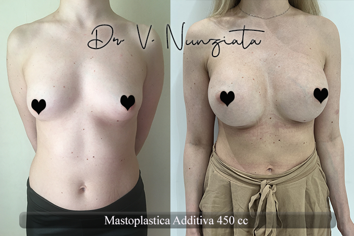 Mastoplastica additiva – protesi rotonde prima e dopo – Paziente 56 – Dr. Vincenzo Nunziata, chirurgo plastico – foto 1