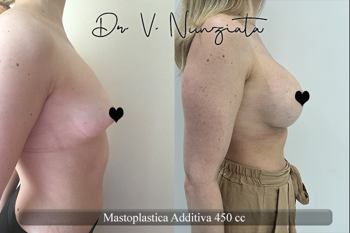 Mastoplastica additiva – protesi rotonde prima e dopo – Paziente 56 – Dr. Vincenzo Nunziata, chirurgo plastico – foto 4