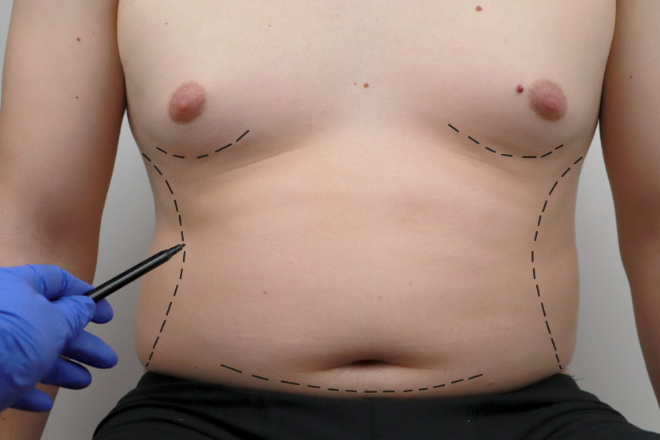 Galleria prima e dopo: lipofilling – Dr. Vincenzo Nunziata